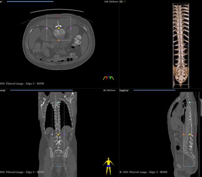 Loading patient CT